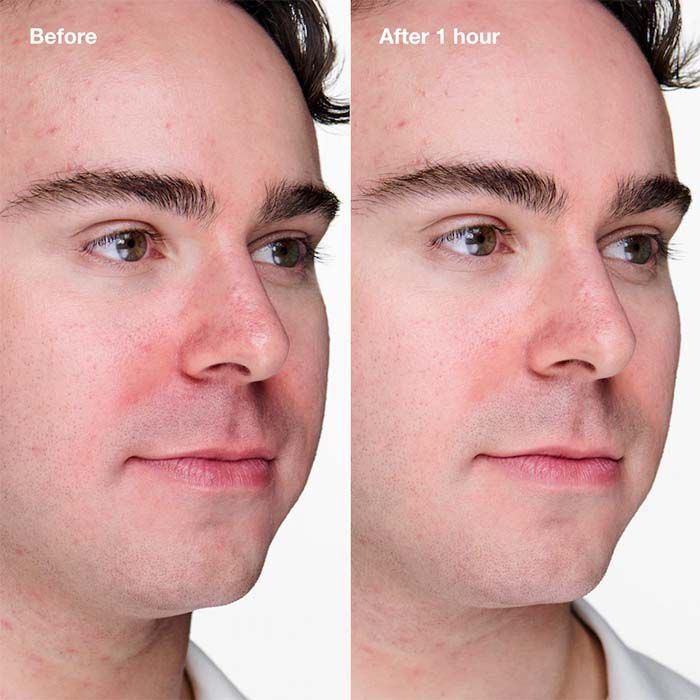 Anti-Blemish Solutions Clinical  20ml-229378 1